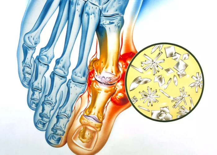 Crystal-Induced Arthropathies Care and Treatment