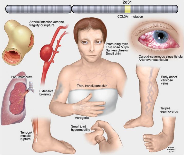 Connective Tissue Disorder Management